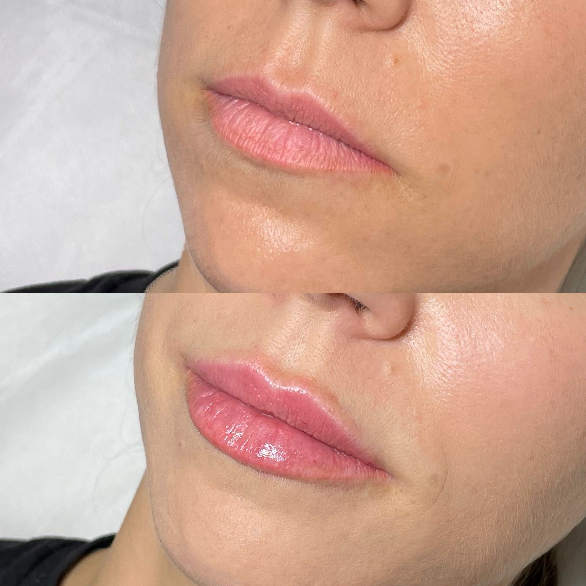 Lip Filler London: A Modern Guide to Elegant Lip Enhancement