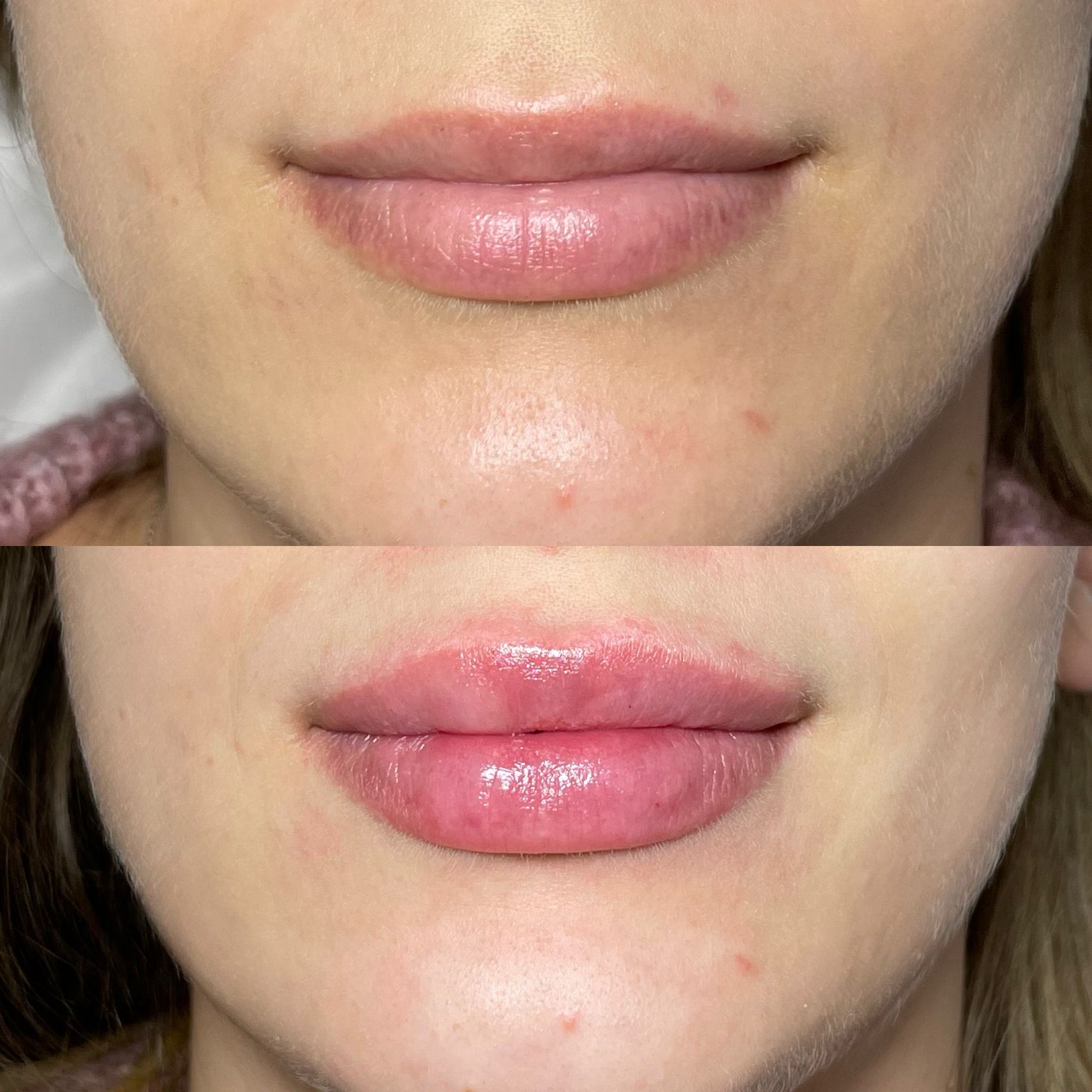 Lip Filler London: A Modern Guide to Elegant Lip Enhancement